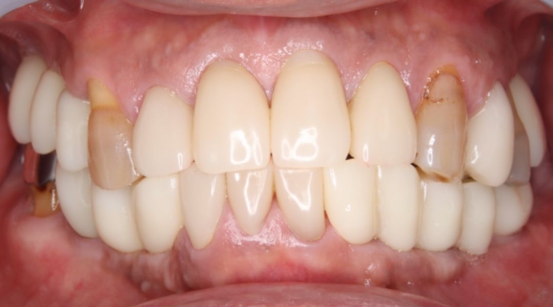 インプラント治療後