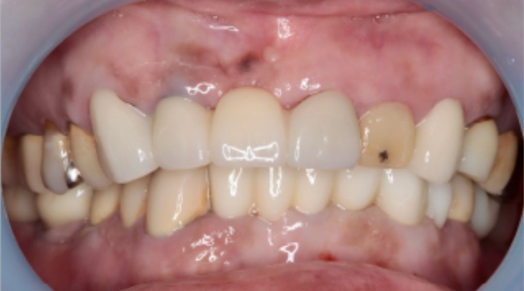 インプラント治療後