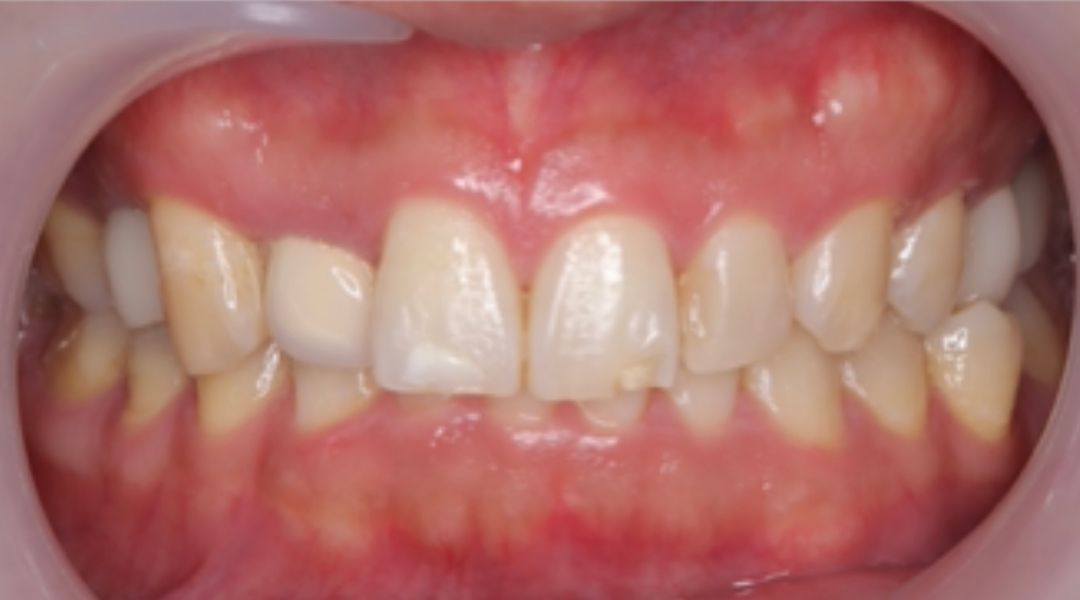 インプラント治療後