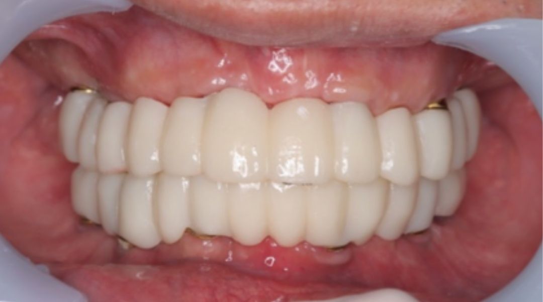 インプラント治療後