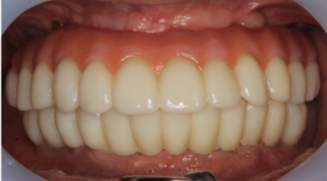 インプラント治療後