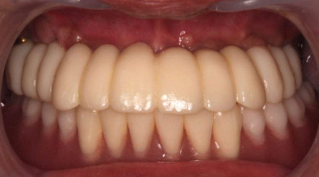 インプラント治療後