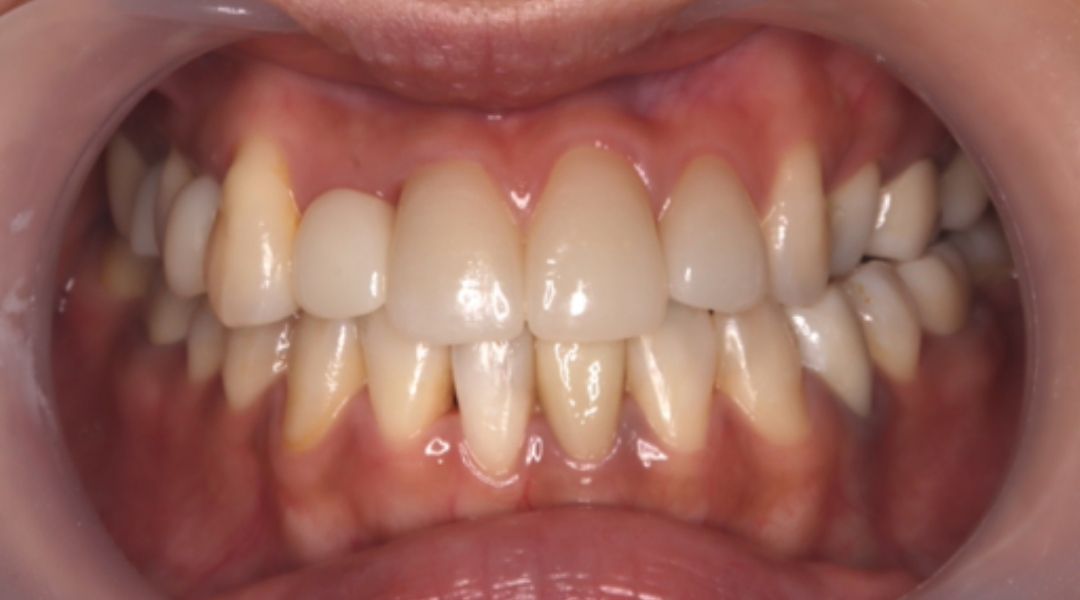 インプラント治療後