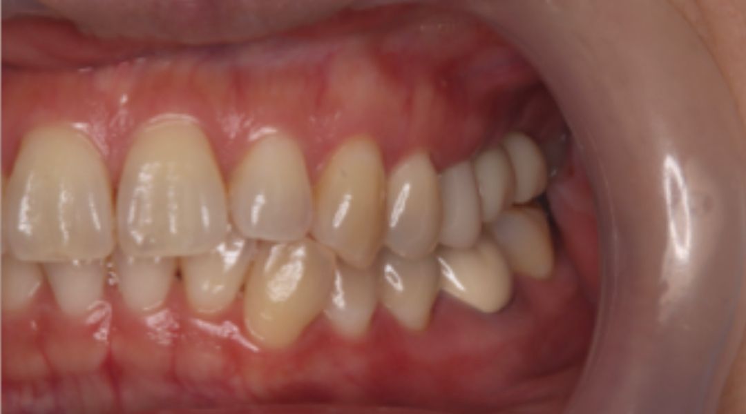 インプラント治療後