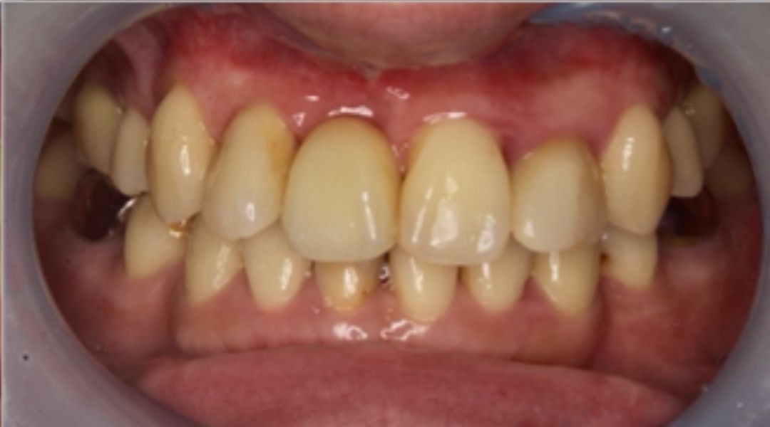 インプラント治療後