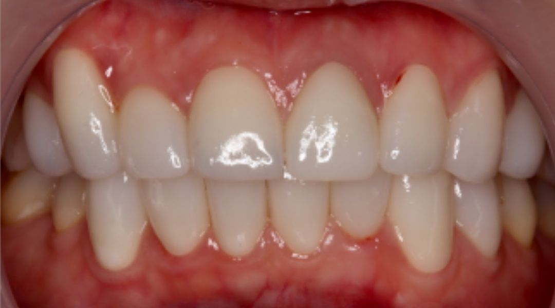 インプラント治療後