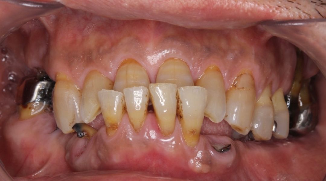 インプラント治療前