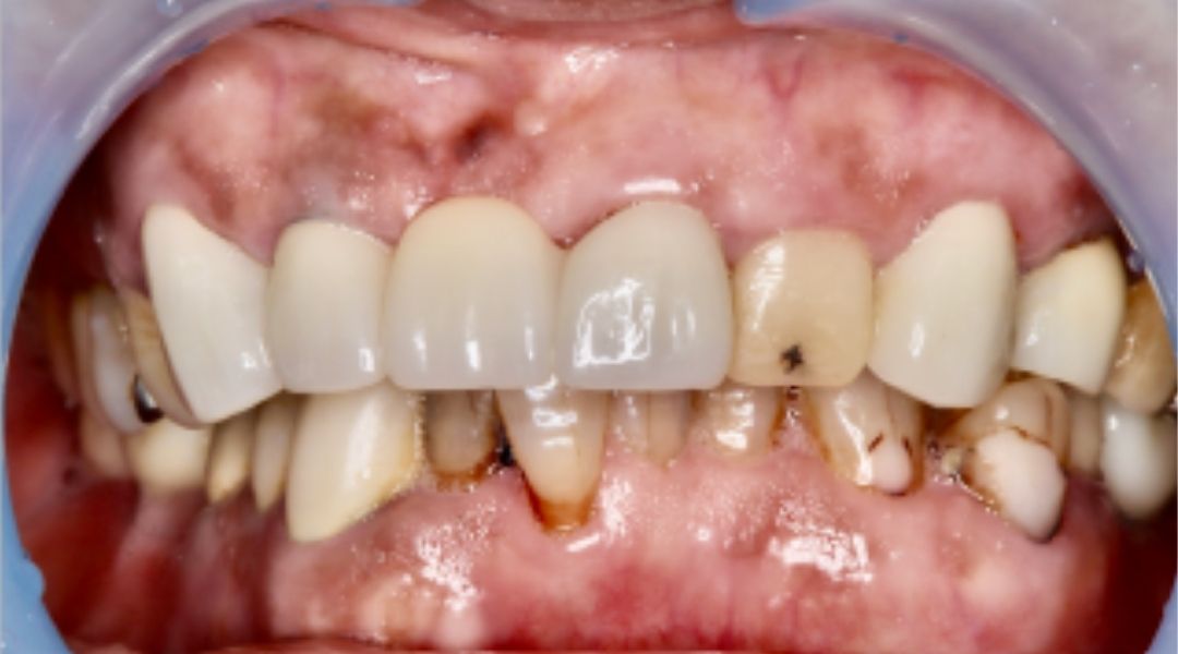 インプラント治療前