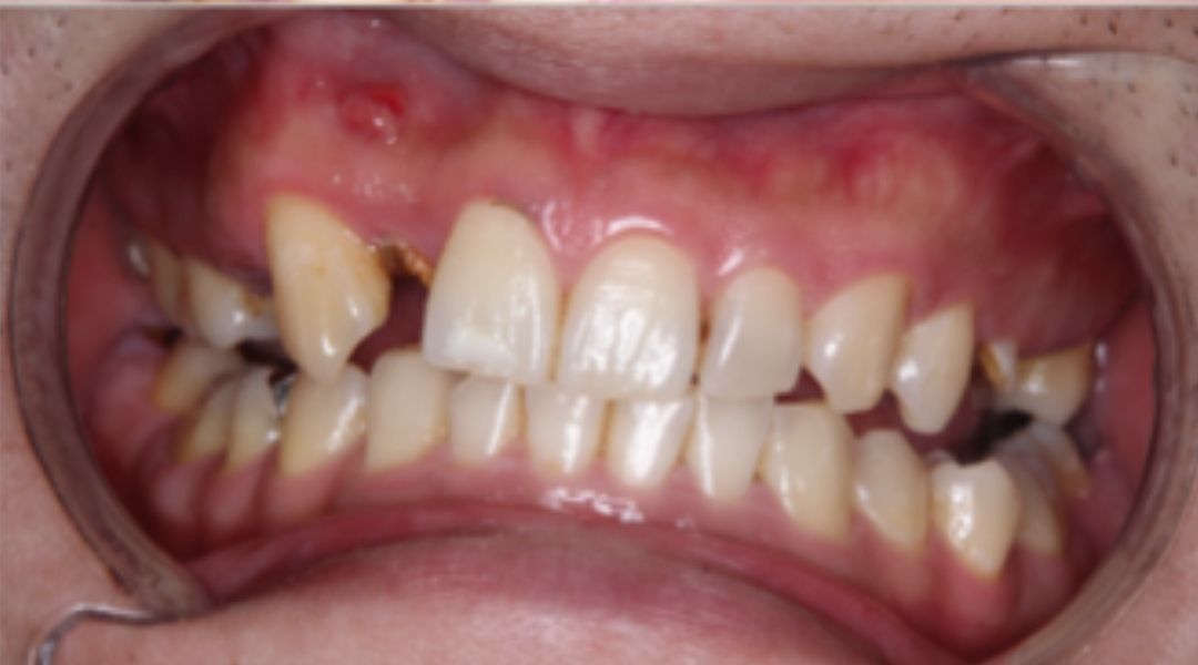 インプラント治療前