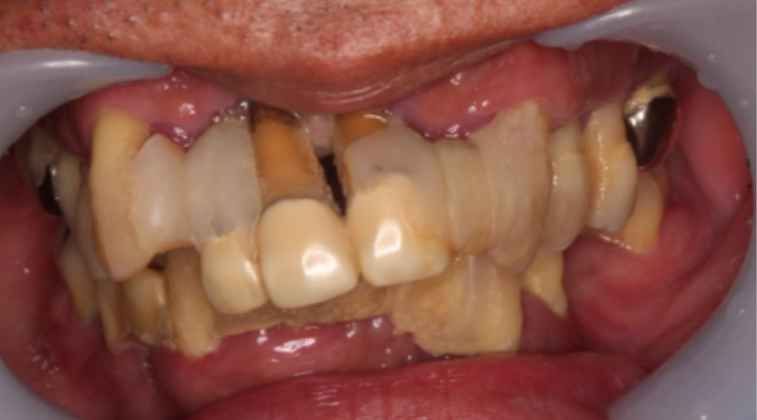 インプラント治療前