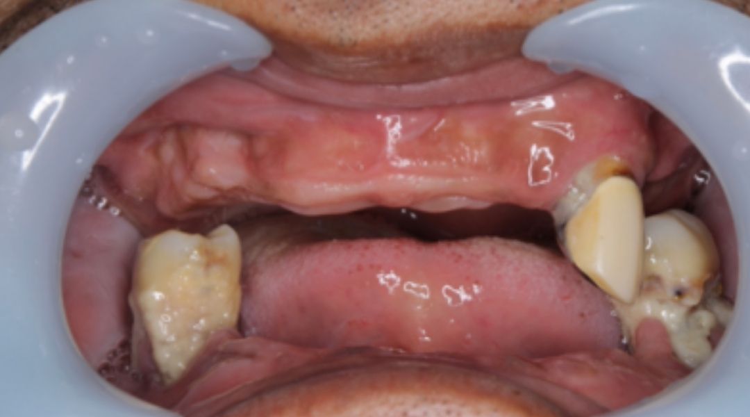 インプラント治療前