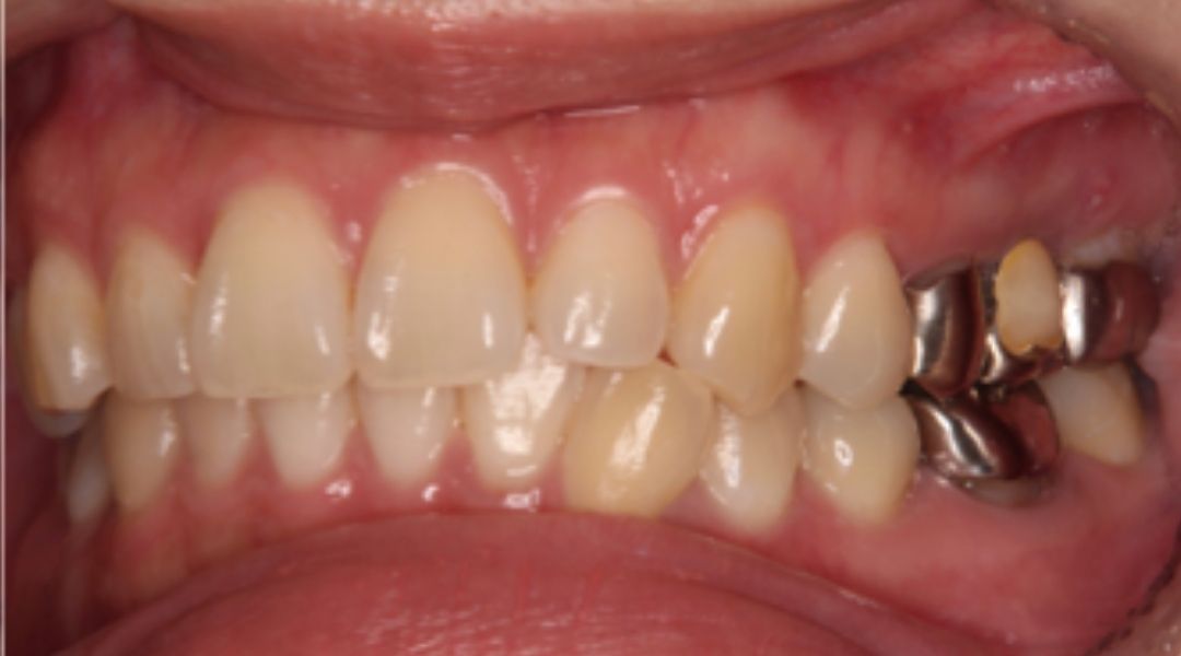 インプラント治療前