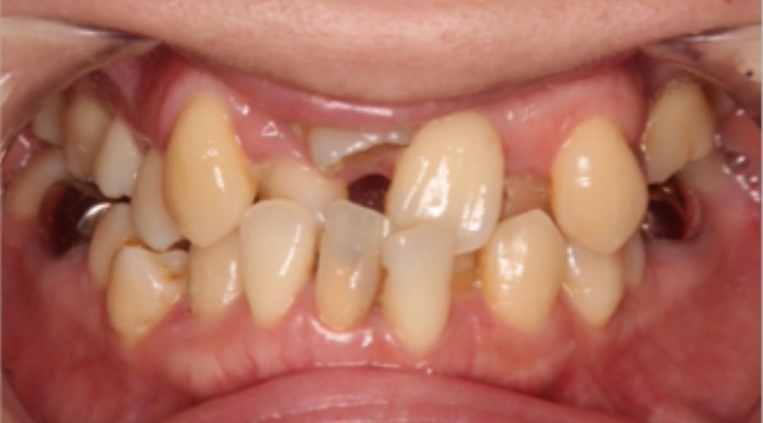 インプラント治療前