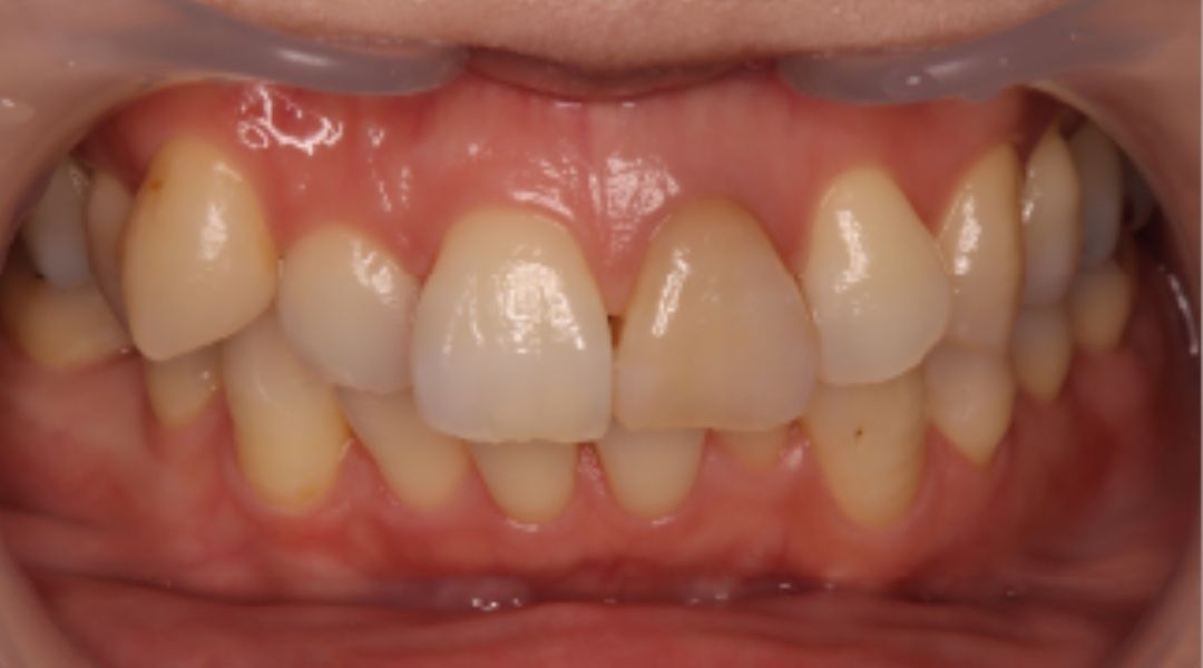 インプラント治療前