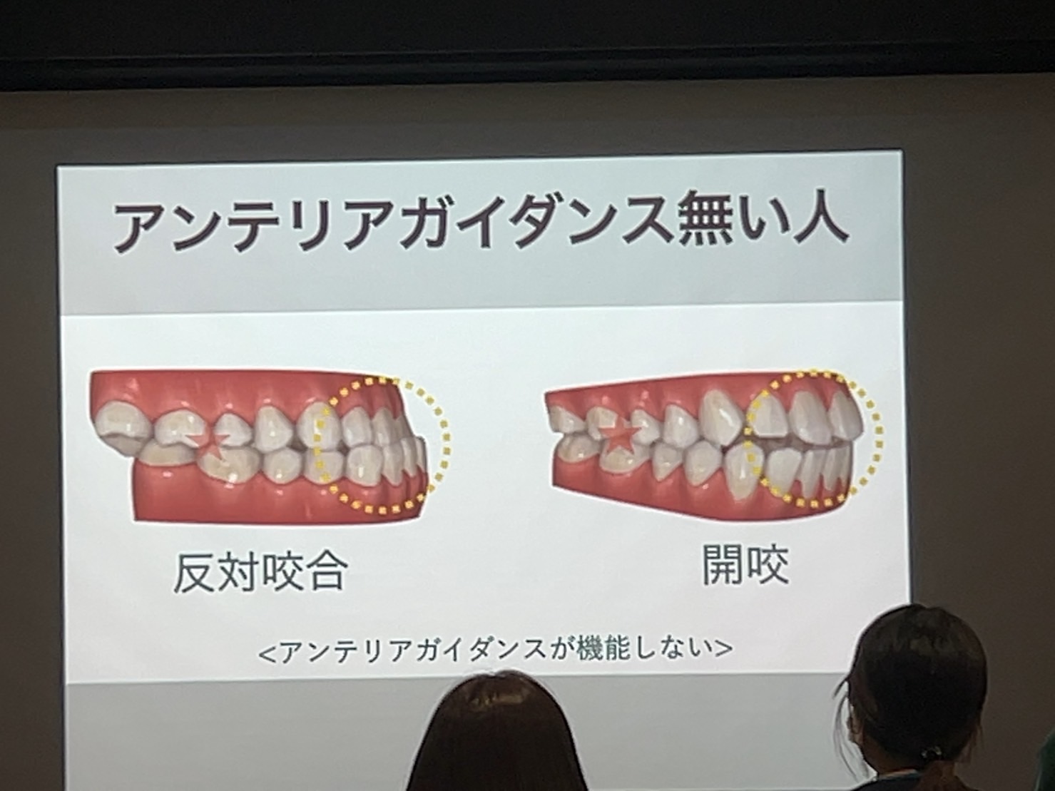 インプラント撤去の原因について | デンタルチームジャパン