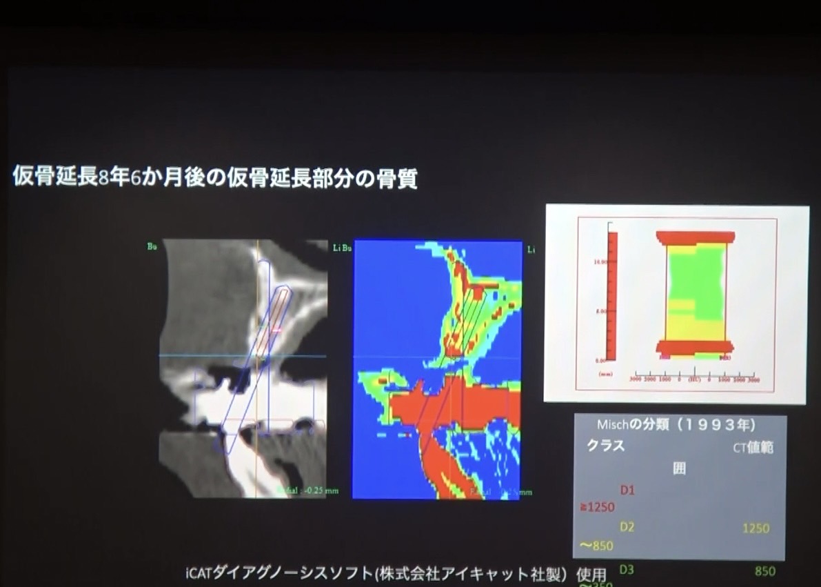 顎骨延長術の臨床応用 インプラント治療における顎骨シミュレーション - 新谷悟の歯科口腔外科塾